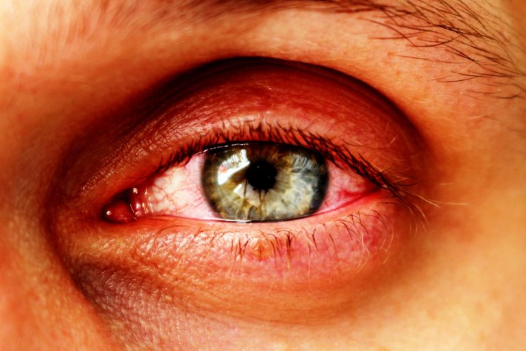 Augeninfarkt – Ursachen, Symptome und Therapie – Heilpraxis