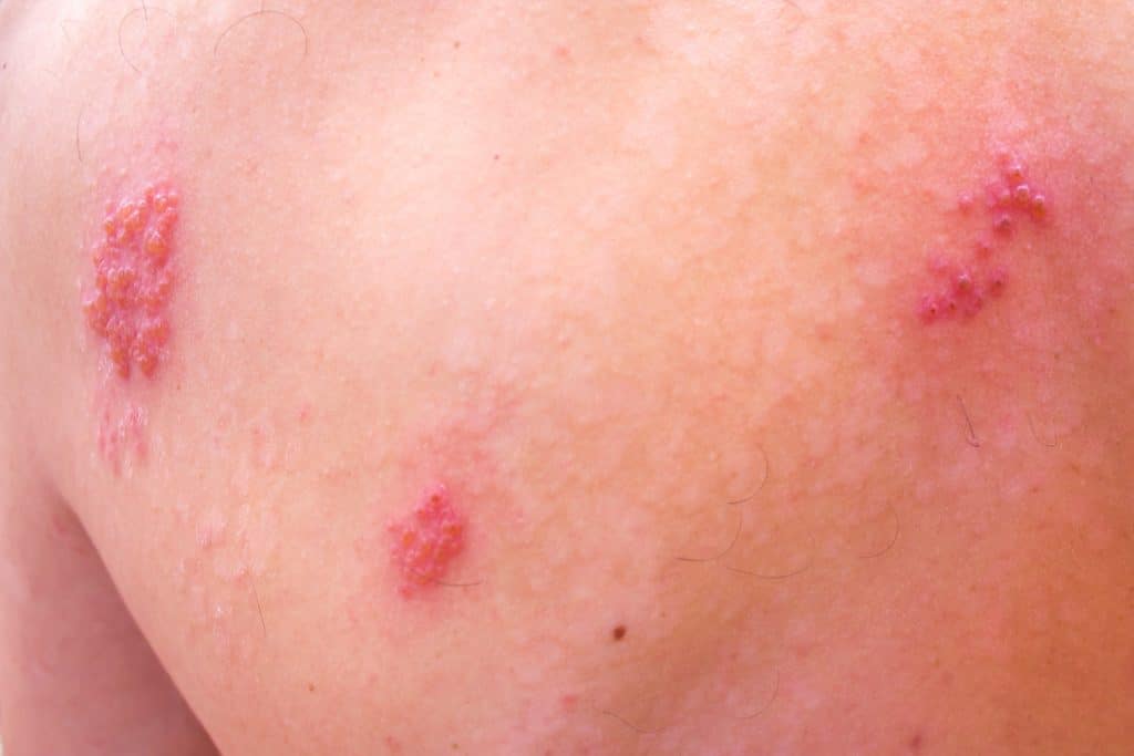 Hautinfektionen und rote Punkte auf der Haut.