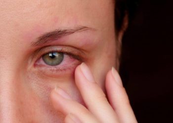 Ein rotes Auge ist oftmals das erste Anzeichen für eine Bindehautentzündung.(Bild: julia_diak/fotolia.com)