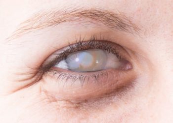 Eine Hornhautentzündung ist eine gefährliche Augenerkrankung. Bei schweren Verläufen kann das Sehvermögen dauerhaft beeinträchtigt werden, beispielsweise durch eine anhaltende Hornhauttrübung. (Bild: Alessandro Grandini/fotolia.com)