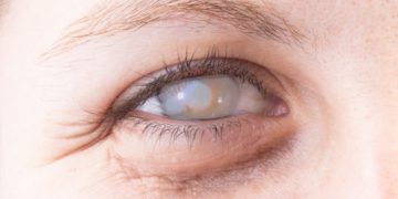 Eine Hornhautentzündung ist eine gefährliche Augenerkrankung. Bei schweren Verläufen kann das Sehvermögen dauerhaft beeinträchtigt werden, beispielsweise durch eine anhaltende Hornhauttrübung. (Bild: Alessandro Grandini/fotolia.com)