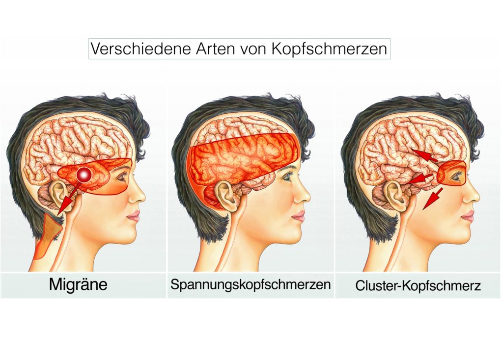 Hinterkopf ich am habe kopfschmerzen Schmerzen im