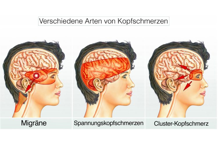 Kopfschmerzen vom Hinterkopf ausstrahlend Symptome, Ursachen, Naturheilkunde Heilpraxis