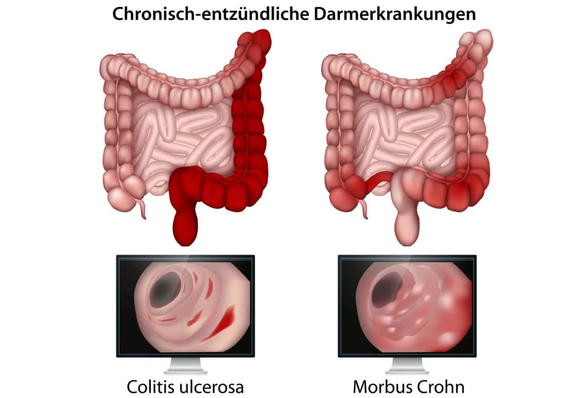 Chronisch Entzündliche Darmerkrankungen Sprechstunde – HWDYNP