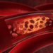 LDL und andere cholesterinhaltige Lipoproteine sind unmittelbar an der Entstehung und dem Fortschreiten der Arteriosklerose (Arterienverkalkung) beteiligt. (Bild: psdesign1/fotolia.com)