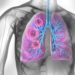 Lungenkrebs ist die gefährlichste aller Atemnot-Ursachen. (Bild: psdesign1/fotolia.com)