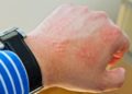 Quaddeln auf der Haut können durch "harmlose" Auslöser wie einen Griff in die Brennnesseln entstehen. Ursächlich kann aber z. B. auch eine allergische Reaktion sein. (Bild: Jürgen Fälchle/fotolia.com)