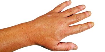 Ödeme können unterschiedlichste Ursachen haben und an verschiedenen Stellen des Körpers auftreten. Oft sind sie harmlos und gehen von alleine wieder zurück. (Bild: bennytrapp/stock.adobe.com)