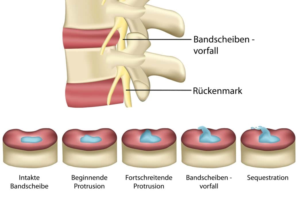 Bandscheibenvorfall Symptome, Ursachen und Behandlung Heilpraxis