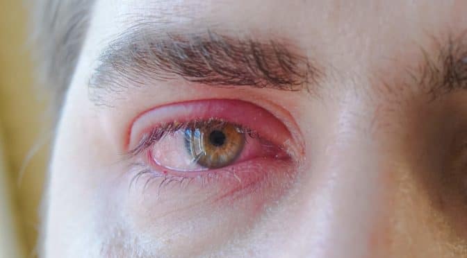 Blepharitis Lidentzündung; Lidrandentzündung