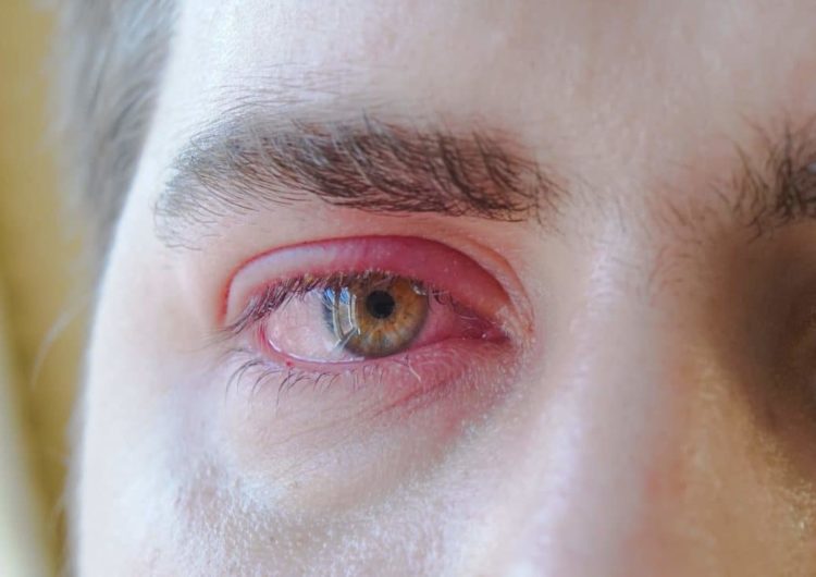 Blepharitis Lidentzündung; Lidrandentzündung Heilpraxis