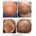 Durch das Ekzem-Medikament Dupilumab konnte bei einer Patientin mit vollständiger Glatze neues Haarwachstum initiert werden. (Bild: American Medical Association/eigene Bearbeitung)