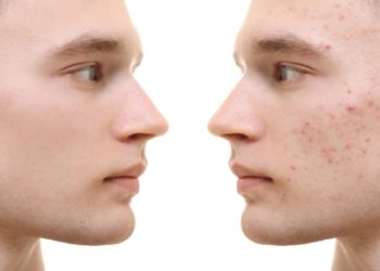 Unreine Haut zeigt sich meistens durch Mitesser und Pickel. (Bild: Africa Studio/fotolia.com)