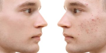 Unreine Haut zeigt sich meistens durch Mitesser und Pickel. (Bild: Africa Studio/fotolia.com)