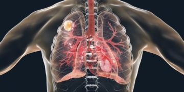 Werden Schimmelpilze eingeatmet, kann es unter Umständen zu einem sogenannten Aspergillom kommen, wenn sich die Pilze z. B. in Lungenhohlräumen einnisten. (Bild: Kateryna_Kon/fotolia.com)