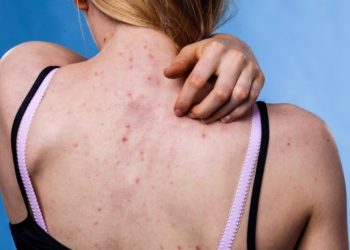 Bei Pickeln am Rücken ist die Behandlung sehr von den Ursachen abhängig. (Bild: Voyagerix/fotolia.com)