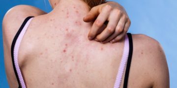 Bei Pickeln am Rücken ist die Behandlung sehr von den Ursachen abhängig. (Bild: Voyagerix/fotolia.com)