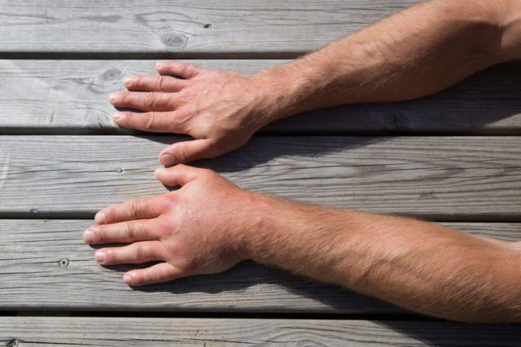 Geschwollene Hände Ursachen, Diagnose und Behandlung Heilpraxis