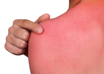 Ein Hautbrennen kann vielen harmlosen Ursachen geschuldet sein, es kann aber auch in seltenen Fällen zu einer Beschwerde werden, welche unbedingt ärztlich abgeklärt werden sollte. (Bild: Dimid/fotolia.com)