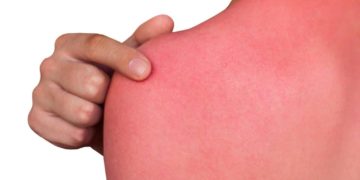 Ein Hautbrennen kann vielen harmlosen Ursachen geschuldet sein, es kann aber auch in seltenen Fällen zu einer Beschwerde werden, welche unbedingt ärztlich abgeklärt werden sollte. (Bild: Dimid/fotolia.com)