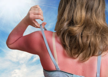 Einen Sonnenbrand kennen sicherlich viele, aber auch hier ist Vorsicht geboten, denn durch ein zu langes Sonnenbad ohne vernünftigen UV-Schutz kann die Haut langfristige Schäden bekommen. (Bild: vchalup/fotolia.com)