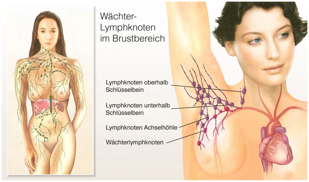 Schmerzhaft nicht knoten achselhöhle Lymphknotenschwellung in