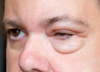 Lidödem kann einseitig oder beidseitig vorkommen, je nachdem, welche Ursache der Schwellung zugrunde liegt. (Bild: milkovasa/fotolia.com)