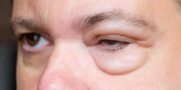 Lidödem kann einseitig oder beidseitig vorkommen, je nachdem, welche Ursache der Schwellung zugrunde liegt. (Bild: milkovasa/fotolia.com)