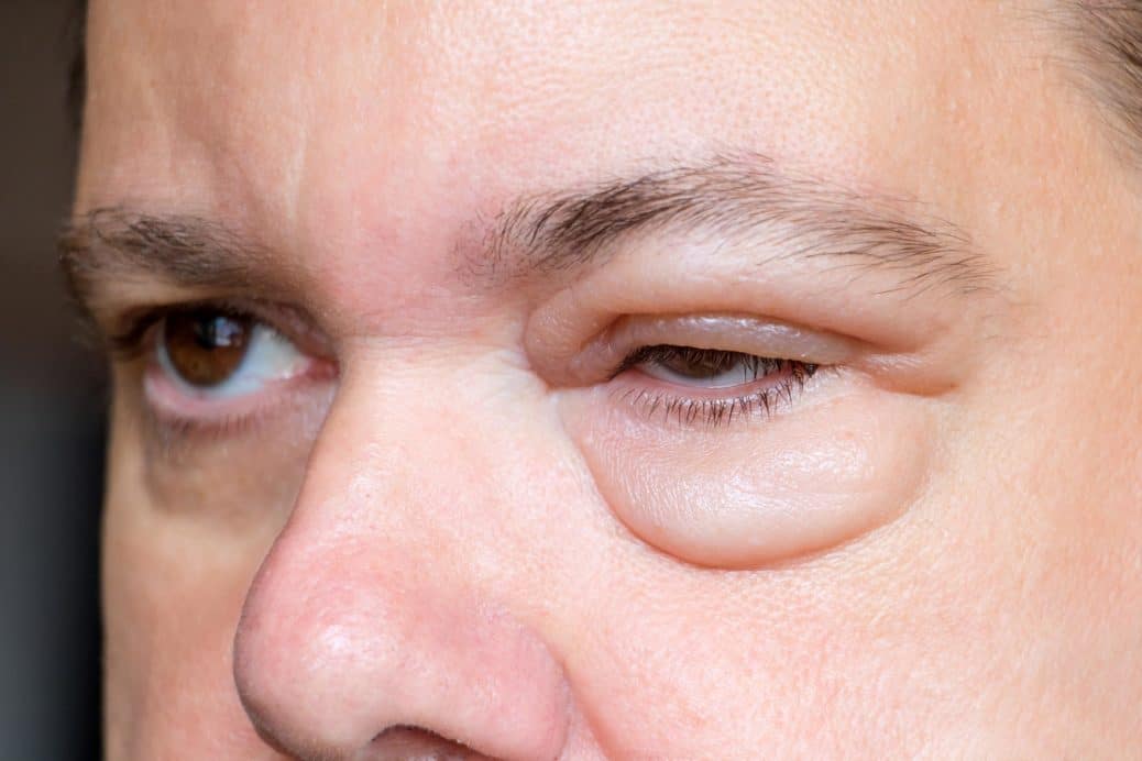 Augenschwellungen Geschwollene Augen Lidodem Heilpraxis