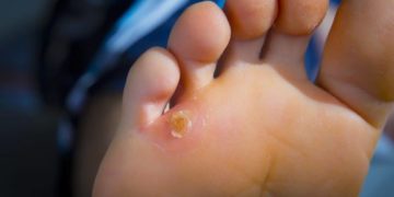 Hühneraugen sind durch den nach innen gerichteten Sporn meist sehr schmerzhaft und sollten behandelt werden. (Bild: hriana/fotolia.com)