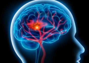 In einer kürzlich veröffentlichten Metaanalyse zeigen sich deutliche Hinweise auf einen Zusammenhang zwischen dem Auftreten von aneurysmatischen Hirnblutungen und den Risikofaktoren Bluthochdruck und Rauchen. (Bild: peterschreiber.media/fotolia.com)
