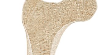 Bei einer Osteomyelitis treten Infektionen im Knochenmark und in angrenzenden Knochenbereichen auf. (Bild: Peter Hermes Furian/fotolia.com)