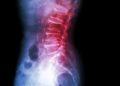 Eine Spondylolisthese ist eine seltene Deformität am unteren Rücken, die auch unter dem Begriff Wirbelgleiten bekannt ist. (Bild: stockdevil/fotolia.com)