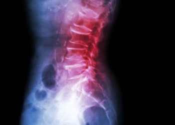 Eine Spondylolisthese ist eine seltene Deformität am unteren Rücken, die auch unter dem Begriff Wirbelgleiten bekannt ist. (Bild: stockdevil/fotolia.com)