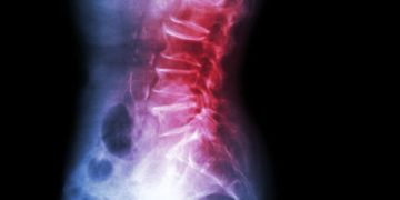 Eine Spondylolisthese ist eine seltene Deformität am unteren Rücken, die auch unter dem Begriff Wirbelgleiten bekannt ist. (Bild: stockdevil/fotolia.com)