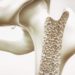 Der Einfluss der Übersäuerung des Körpers auf Osteoporose wurde wissenschaftlich widerlegt. (Bild: crevis/fotolia.com)
