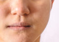 Oftmals kommt es zu Veränderungen der im Nasenbereich, welche häufig in Form rötlicher Entzündungen und Schwellungen bemerkbar machen. (Bild: PORNCHAI SODA/fotolia.com)