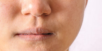 Oftmals kommt es zu Veränderungen der im Nasenbereich, welche häufig in Form rötlicher Entzündungen und Schwellungen bemerkbar machen. (Bild: PORNCHAI SODA/fotolia.com)