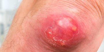 Eine Furunkulose kann verschiedene Ursachen haben, sie kann systemisch bedingt sein oder durch äußere Einflüsse ausgelöst werden. (Bild: andriano_cz/fotolia.com)