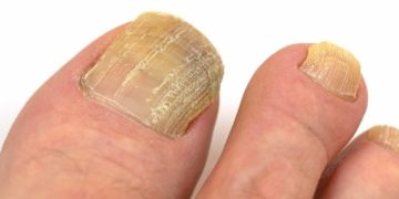Wenn Zehennägel solch gravierende Veränderung erleiden, ist es nicht nur ein ästhetisches Problem, sondern eine Erkrankung. (Bild: M. Schuppich/fotolia.com)