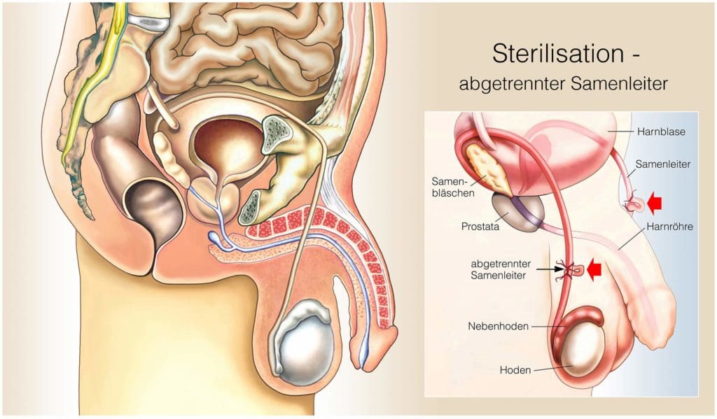 Krankgeschrieben nebenhodenentzündung wie lange Prostataentzündung: Dauer