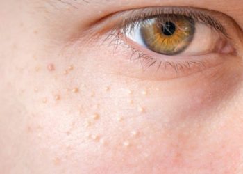 Grießkörner (Milien) treten meist im Gesicht auf und stellen daher ein kosmetisches Problem da. (Bild: vchalup/fotolia.com)