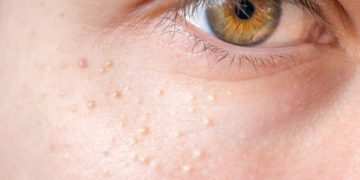 Grießkörner (Milien) treten meist im Gesicht auf und stellen daher ein kosmetisches Problem da. (Bild: vchalup/fotolia.com)