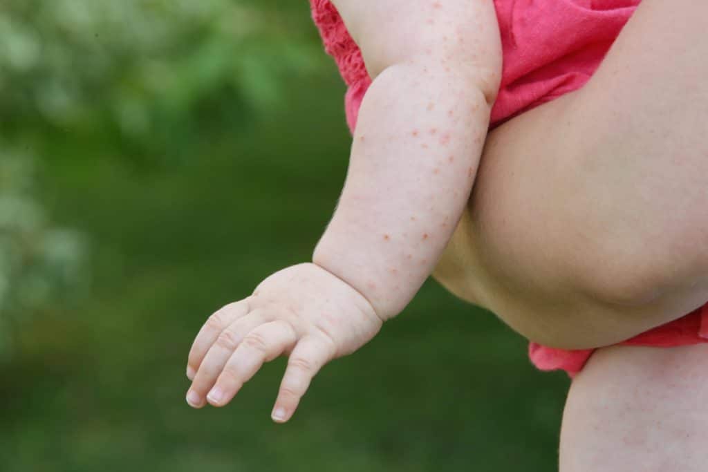 Baby mit Hitzepickeln am Arm wird auf dem Arm getragen