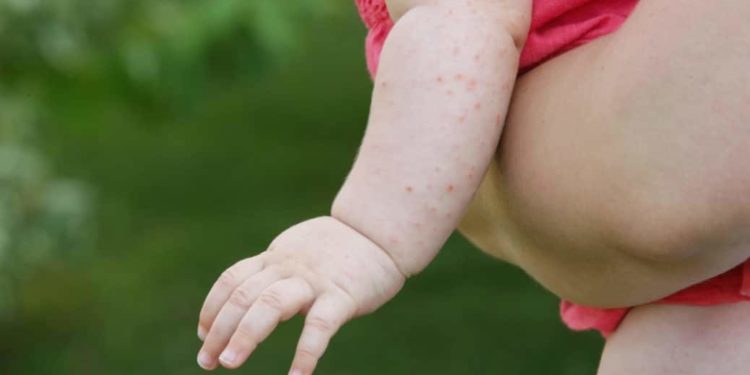 Baby mit Hitzepickeln am Arm wird auf dem Arm getragen