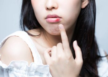 Junge asiatische Frau zeigt mir Finger auf eine Geschwulst an ihrer Unterlippe