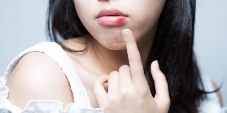 Junge asiatische Frau zeigt mir Finger auf eine Geschwulst an ihrer Unterlippe
