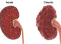 Darstellung einer entzündeten Niere im akuten und einer im chronischen Zustand