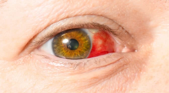Bluterguss im Auge - Ursachen und Gegenmaßnahmen