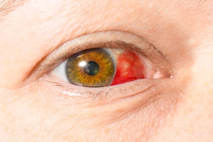 Bluterguss im Auge Ursachen und Gegenmaßnahmen Heilpraxis